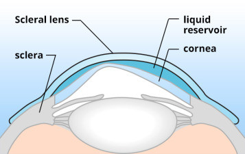 Scleral Contact Lenses