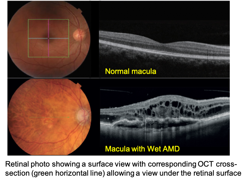 OCT Macular Degeneration in Ajax Ontario OCT detecting macular degeneration in Ajax ON