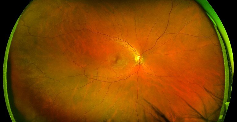 optomap ultra widefield retinal image ajax ontario
