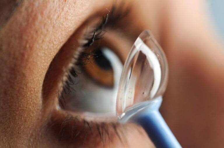 Keratoconus: A Solution using Scleral Contact Lenses