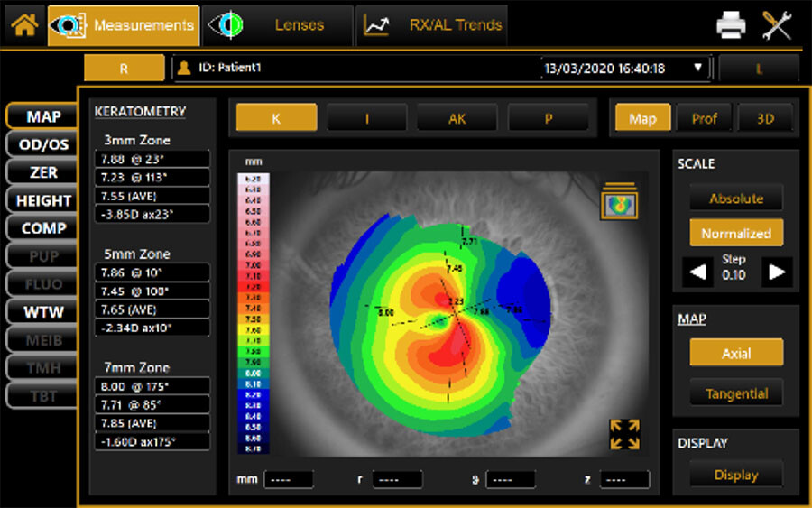 Keratoconus topography for custom scleral contact lenses